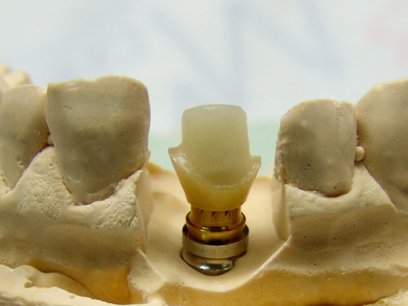 T-base-e-abutment-personalizzato