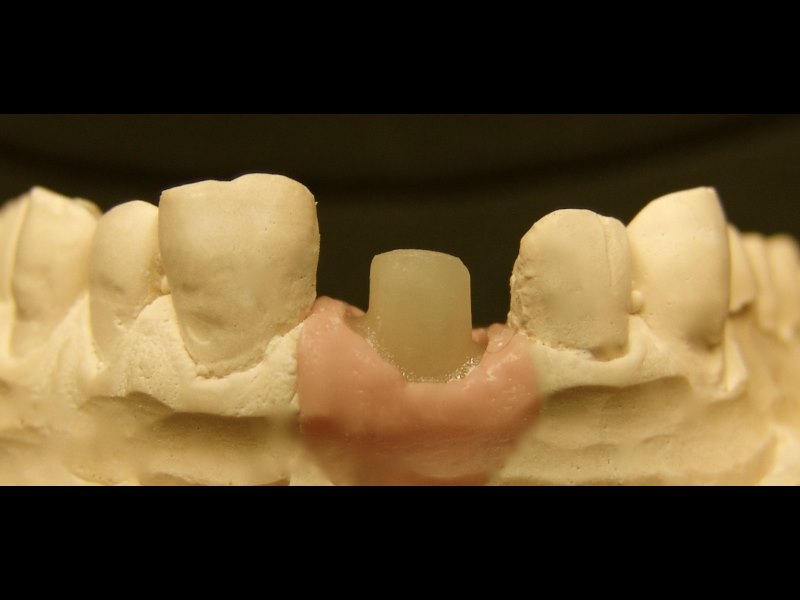 abutment-personalizzato-estetico