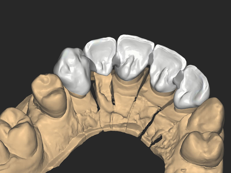 zirconio-3